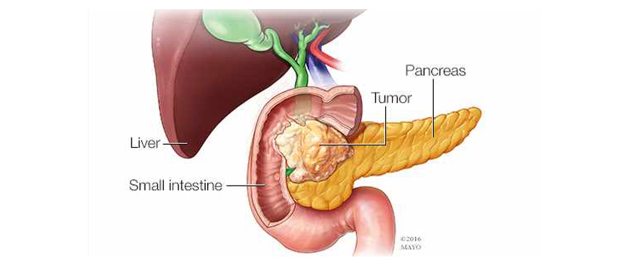 Pancreatic Cancer Research: Latest Developments and Breakthroughs