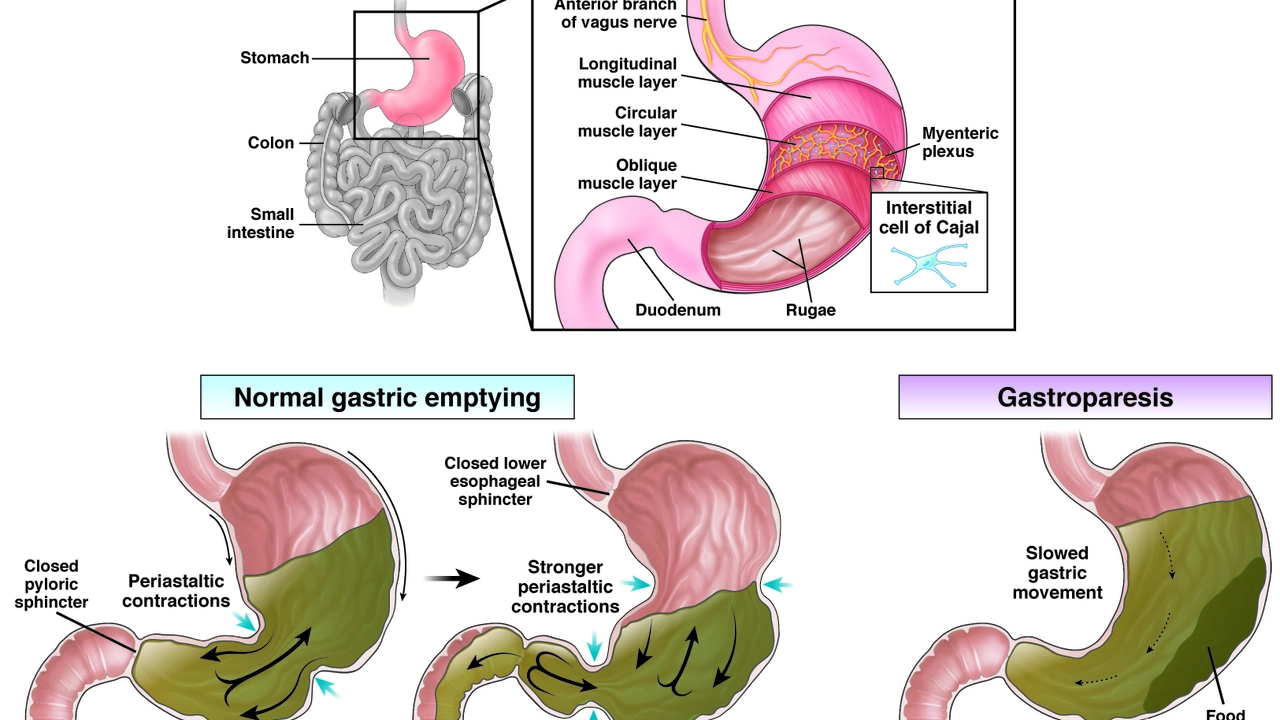 The Role of Exercise in Managing Diabetic Gastroparesis